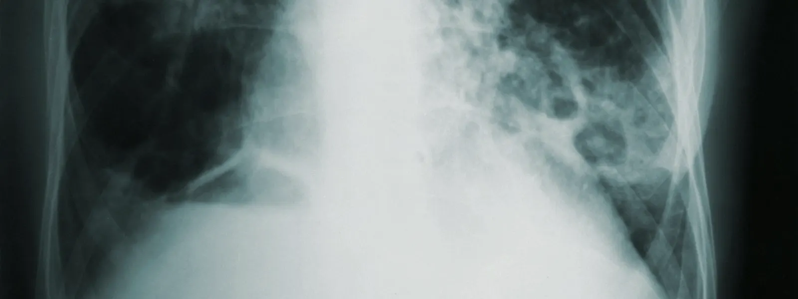 Chest and thoracic X-ray