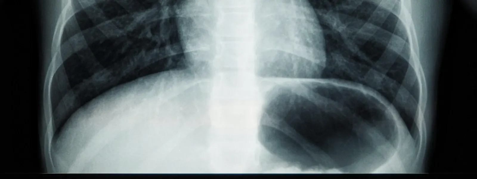 X-ray of the ribcage